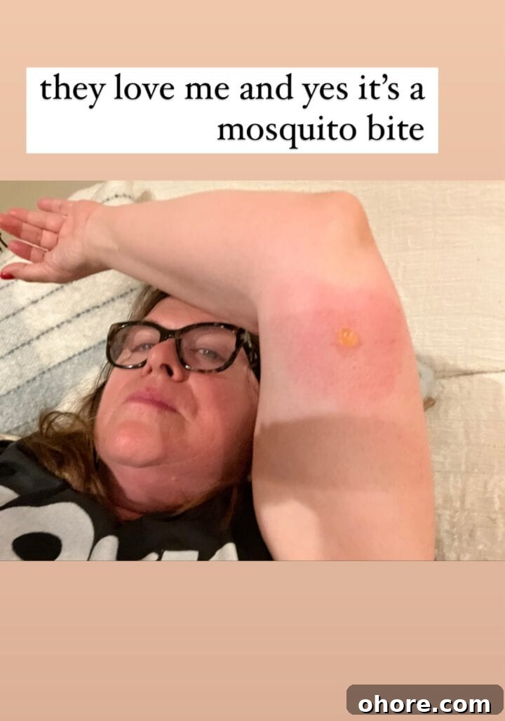 Mosquito Survival Guide: Teri’s Expert Tips for Avoiding Bites 4 woman with blister on arm